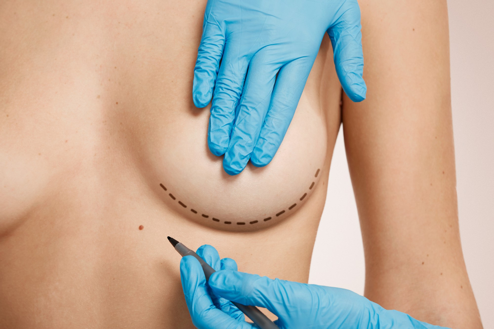 Zväčšenie prsníkov implantátmi 